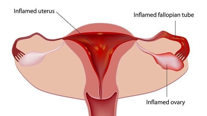 managing mentrual cramps